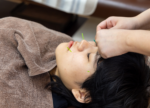 発寒南あおば鍼灸整骨院(一本一本丁寧に刺していきます。)