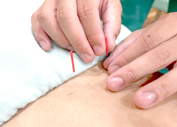 ゆうしん整骨院　アクロスプラザ東久留米【鍼灸】(細い鍼を使用しているため、痛みはほぼございません。)