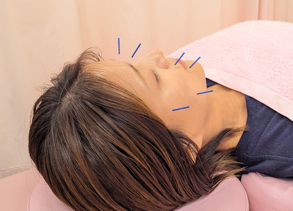 さくら整骨院・はりきゅう院　上板橋駅院(お顔のシワ・たるみ・クマなどの改善が目指せます。)