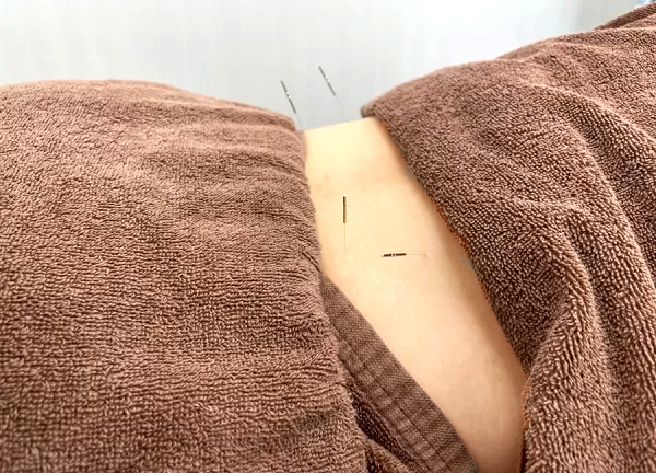 甲斐整骨院　新宮院【鍼灸】(細い鍼で一本一本刺していきます。)