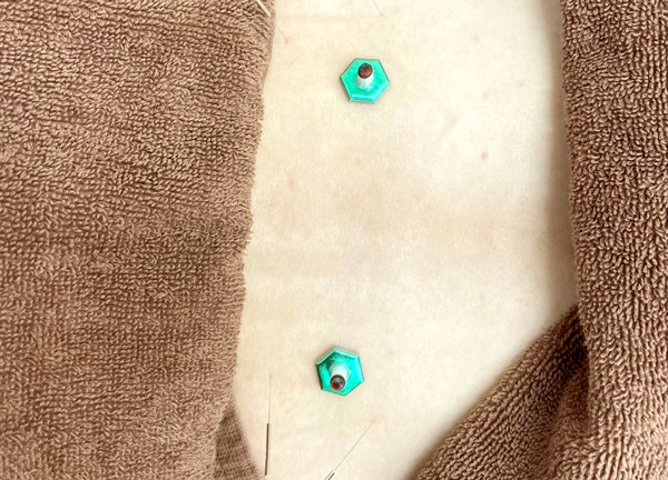 甲斐整骨院　新宮院【鍼灸】(お灸によりお身体を温め硬くなった筋肉をほぐします。)