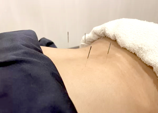 さくら鍼灸整骨院　湘南台院(鍼灸で筋肉の弛緩や血行促進、自律神経の調整をおこないます)