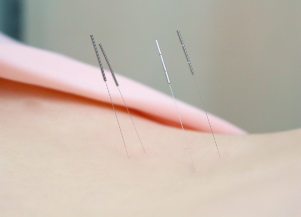京成曳舟駅前プラザ接骨院・はり灸院【鍼灸】(経絡（ツボ）を刺激して本来持っている力を引き出します)