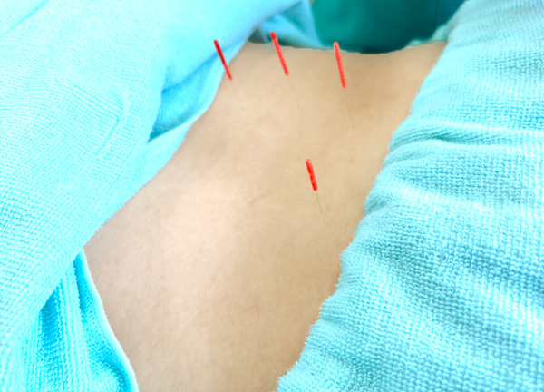 ゆうしん鍼灸整骨院　朝霞(鍼で手技では届きにくい深層にある筋肉をほぐしコリや痛みを緩和させます。)