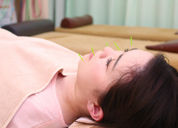 セントラル接骨院　西台【鍼灸】(肌荒れや顔のむくみは美容鍼でアプローチします)