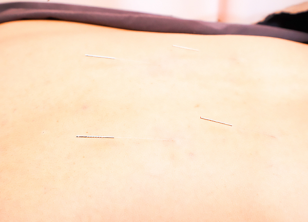あおば総合治療院　イオン大和院【鍼灸】(深部のこり固まった筋肉は鍼でアプローチします。)