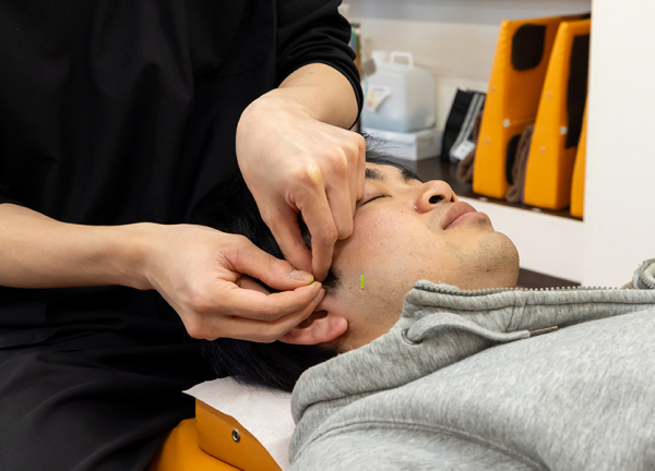 北４２条あおば鍼灸整骨院(一本一本丁寧に刺していきます。)