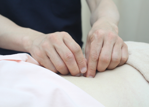 やすらぎ接骨院【鍼灸】(一本一本丁寧に刺していきます♪)