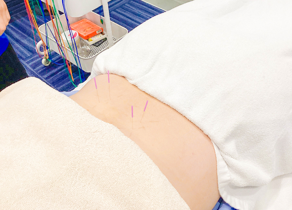 スポーツ総合治療院ＡＣＴ　学芸大学店【鍼灸】(鍼の力で本来持っている力を引き出します。)
