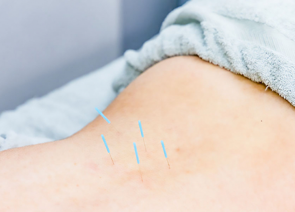 南７条あおば整骨院【鍼灸】(鍼は細いものを使用していますので、痛みはほぼございません。)