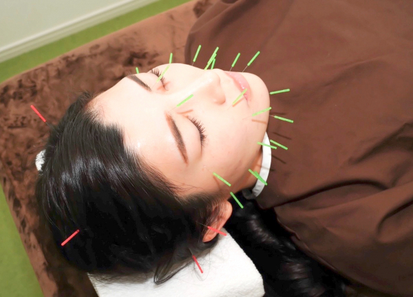 Ｔｏｍはり灸院【鍼灸/マッサージ】(お顔の鍼で肌質やツヤをキレイにします☆)