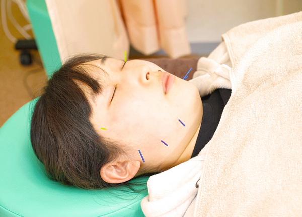 ひだまり整骨院・ひだまり鍼灸マッサージ院 (美容鍼でシワやくすみの緩和を行います。)