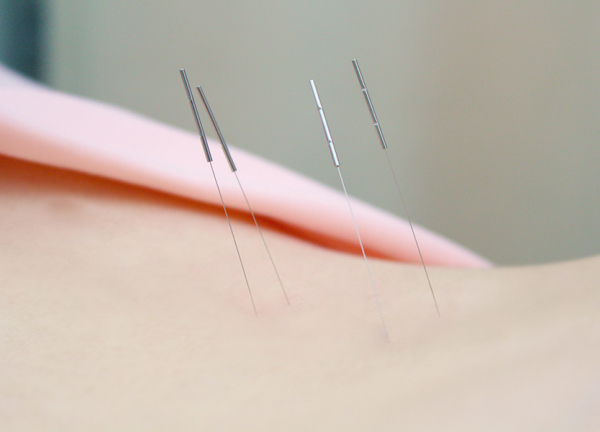 東洋堂接骨院　はり灸マッサージ院(経絡（ツボ）を刺激して本来持っている力を引き出します)