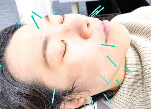 文の里駅前整骨院　阿倍野区院【鍼灸】(お顔まわりのお悩みは美容鍼でアプローチします。)