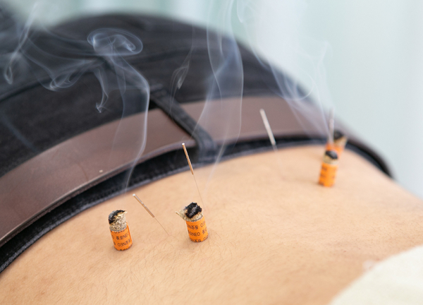 西尾すずらん鍼灸接骨院(お灸でお身体を温めていきます。)