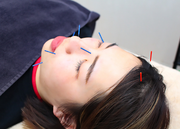 東松原駅の接骨院・はり灸院(肌荒れの対応にも効果が期待できます)