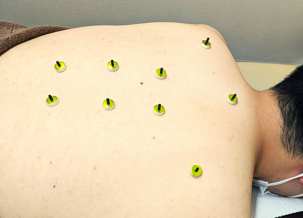 エルフィン北広整骨院【鍼灸】(熱による刺激を与える事で血行を促進させ不調の緩和が期待できます。)