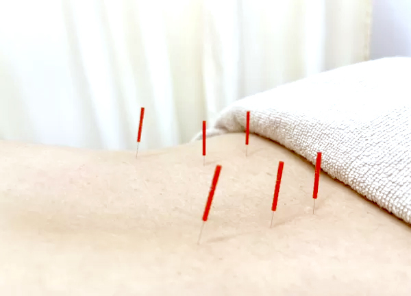 さくら鍼灸・接骨院　希望ヶ丘院(鍼灸で筋肉の弛緩や血行促進、自律神経の調整をおこないます)