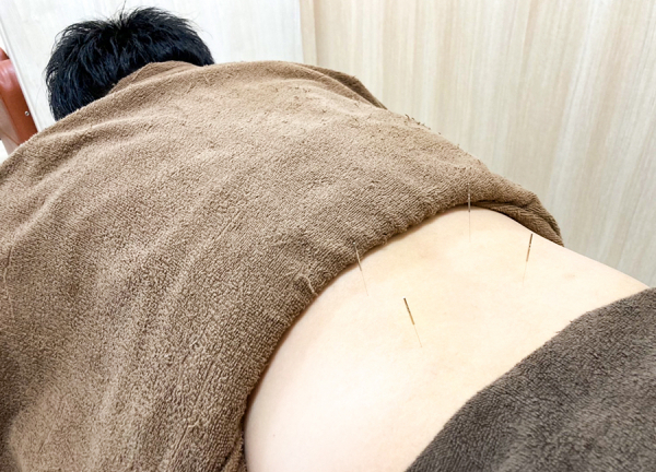 古河上辺見鍼灸接骨院(手技以外にも鍼やお灸による施術をご用意しています。)