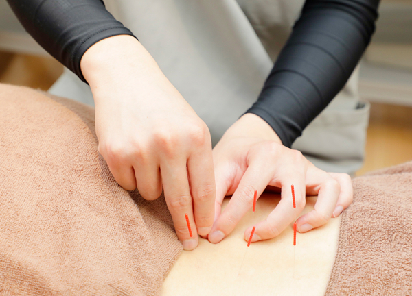 あい鍼灸院・接骨院　笹塚駅院(細い鍼を一本一本刺していきます。)