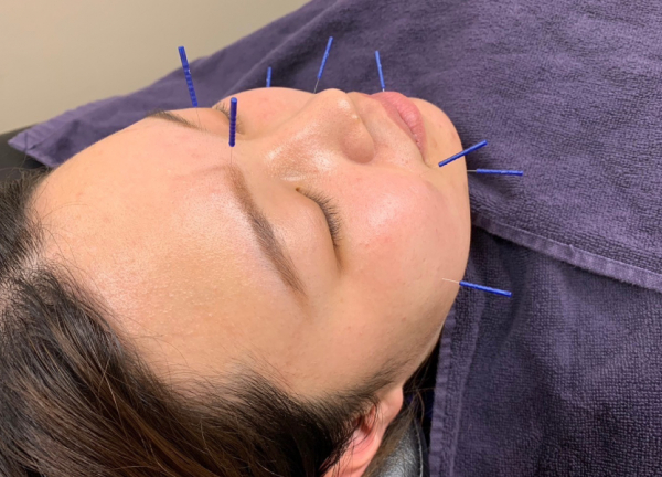 西浦和駅前鍼灸接骨院(顔の肌深層の細胞や筋肉を鍼で刺激し、潤いある肌を目指します。)