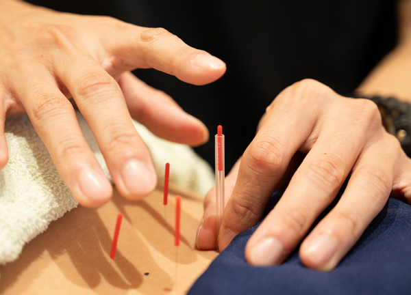 横浜駅西口あおば接骨院はりきゅう院(一本一本丁寧に刺していきます。)