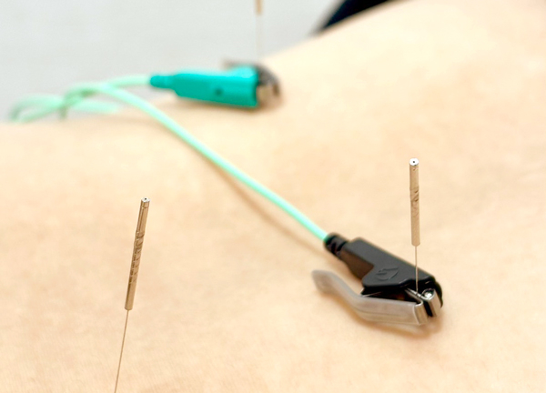 あい鍼灸院・接骨院 仙台ロフト院(鍼灸で筋肉の弛緩や血行促進、自律神経の調整をおこないます)