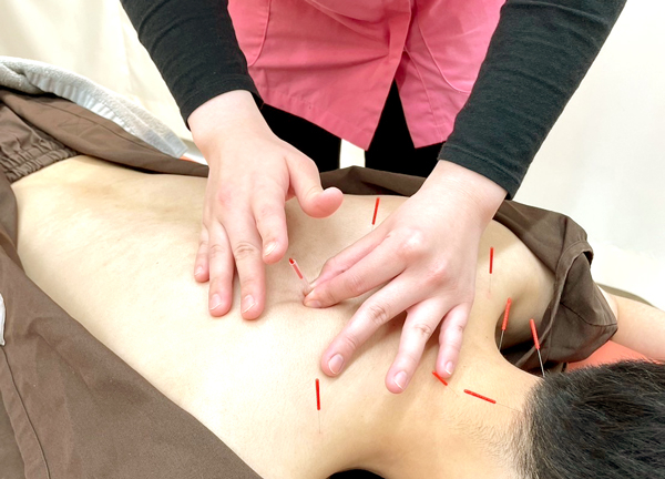 ＧＢＳ巣鴨地蔵通り整骨院・鍼灸院　筋膜整体院(手技では届きにくい身体の深層にある筋肉を鍼で刺激しコリや痛みを緩和させます。)