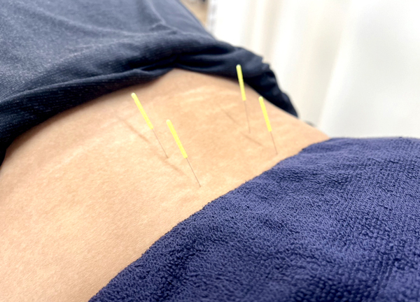 糟屋新宮中央駅前鍼灸接骨院(鍼で身体の深層を刺激し硬くなった筋肉をほぐします。)