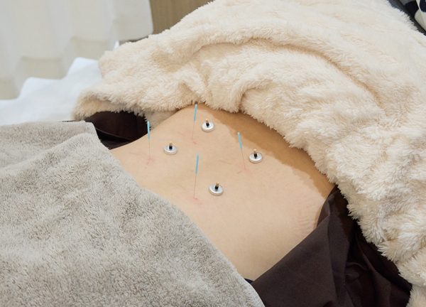 Ｂａｓｉｓ鍼灸整骨院　阿倍野駅・天王寺駅院(体表にあるツボを刺激します。)