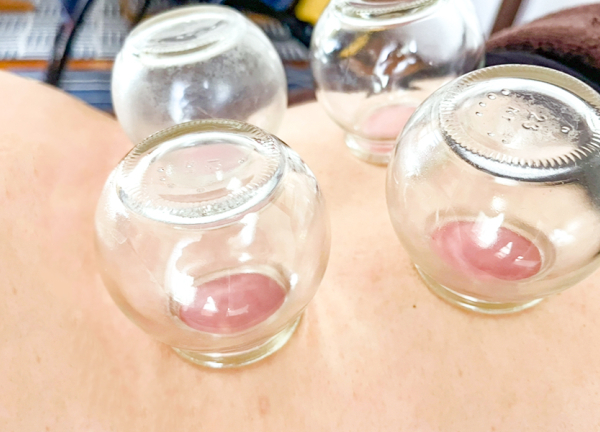 シャローム鍼灸院(カッピングで体内の老廃物を外へ排出します。)