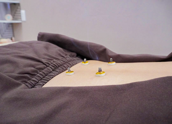 イーライフ鍼灸接骨院　豪徳寺院(お灸による温熱刺激で代謝向上を目指します。)