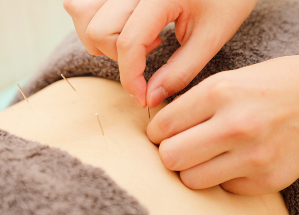ＮＯＭＯＫＯＴＳＵ鍼灸院整骨院　亀有北口院(一本一本丁寧に刺していきます。)