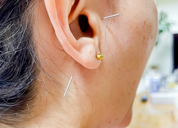 横浜プライベートメディカルプラクティス(経絡を刺激することで体内の調子を整えます。)