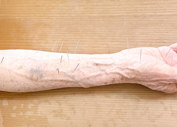 横浜プライベートメディカルプラクティス(細い鍼のため痛みは少ないです。)