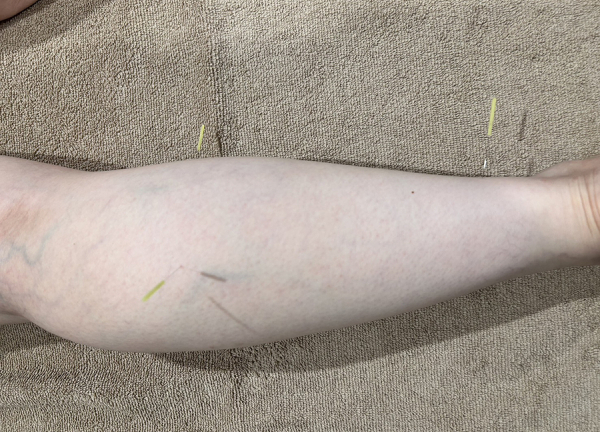 アスリートケアながさわ治療院　【鍼灸】(鍼で脚を刺激して血行促進を図ります。)