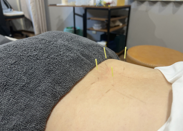 アスリートケアながさわ治療院　【鍼灸】(鍼の力で痛みや不調の改善を目指します。)