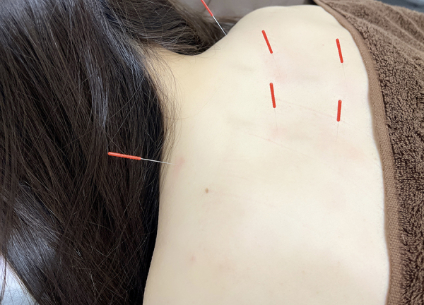 鍼灸アキュティナ（ａｃｕｔｉｎａ）　広島中区院(つらい肩こりの改善を目指します。)