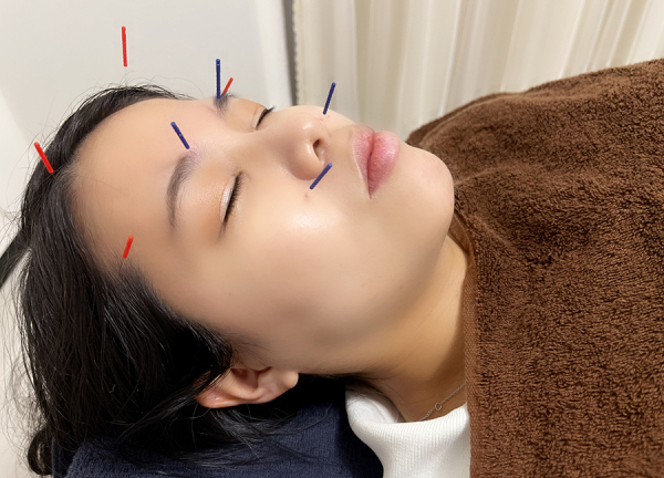 鍼灸アキュティナ（ａｃｕｔｉｎａ）　広島中区院(頭痛や眼精疲労の改善を目指します。)