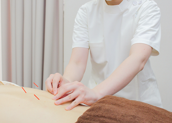 千住大橋駅前はり灸院・整骨院(鍼でお身体を刺激して、お悩みの緩和をおこないます。)