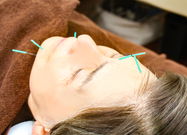 千住大橋駅前はり灸院・整骨院(お顔の肌トラブルの改善を目指します。)