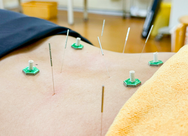 だいち鍼灸院・接骨院　下松院／岸和田(鍼灸施術で深層筋や体表のツボを刺激します。)