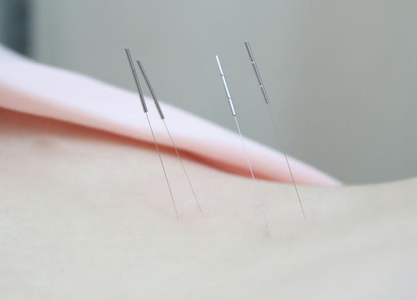 北洋堂接骨院【鍼灸】(経絡（ツボ）を刺激して本来持っている力を引き出します！)